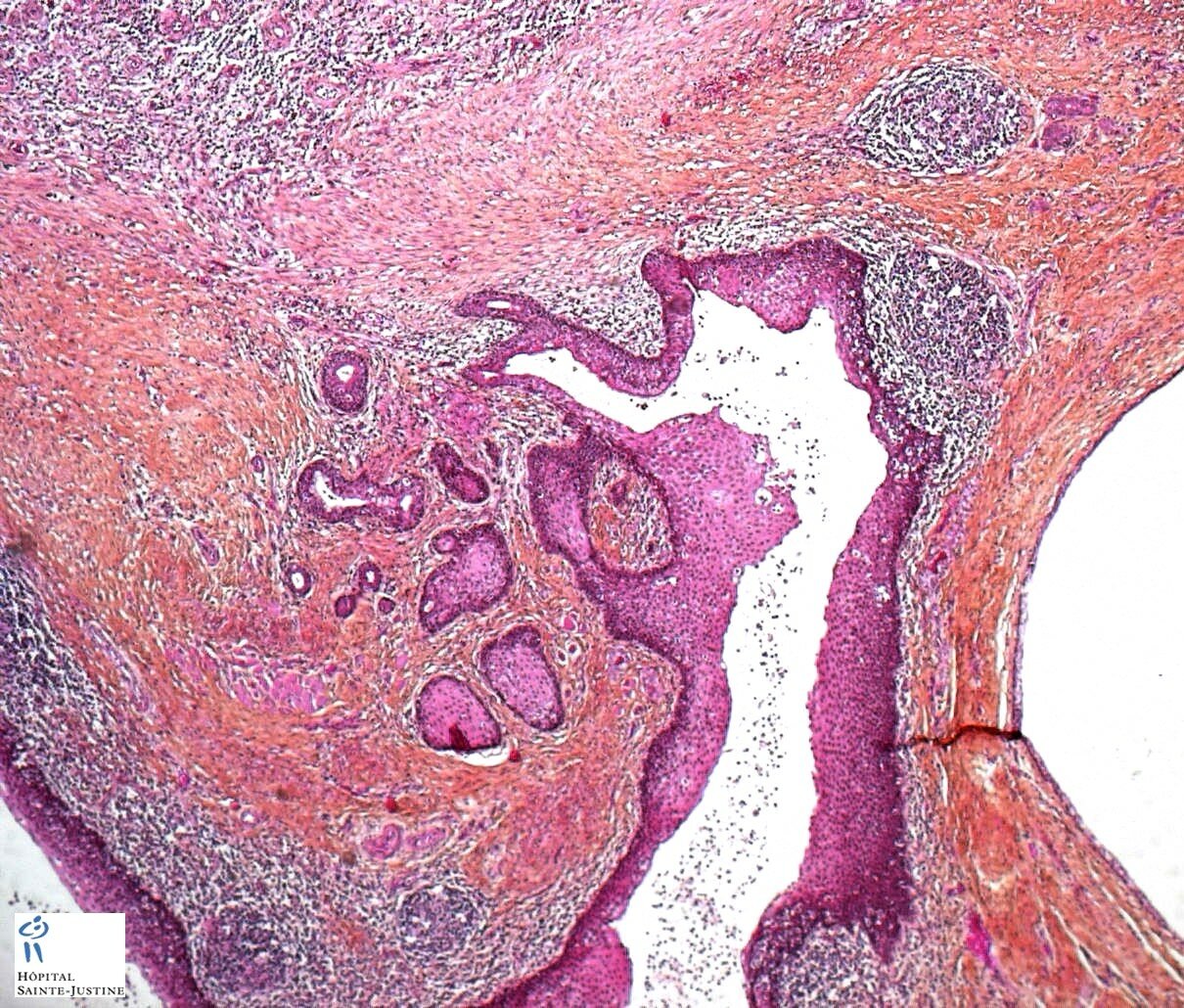 Branchial Cleft Cyst Histology Qiao s Pathology Branchial Cleft Cyst