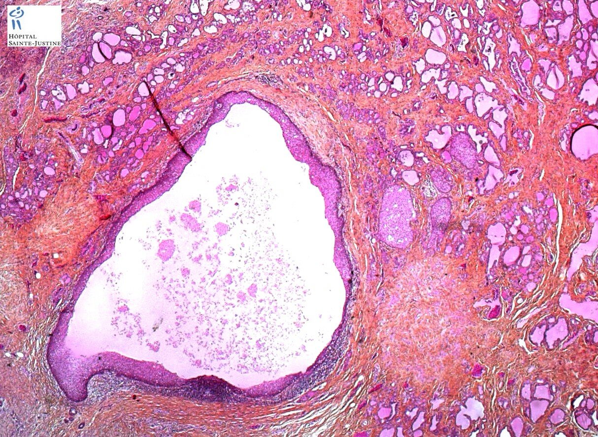 Branchial Cleft Cyst Histology Qiao s Pathology Branchial Cleft Cyst