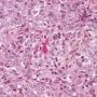 Pulmonary localization of a malignant rhabdoid tumor