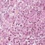 Pulmonary localization of a malignant rhabdoid tumor