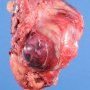 Renal malignant rhabdoid tumor