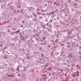 Pulmonary localization of a malignant rhabdoid tumor