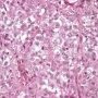 Pulmonary localization of a malignant rhabdoid tumor