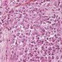 Pulmonary localization of a malignant rhabdoid tumor