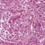 Pulmonary localization of a malignant rhabdoid tumor