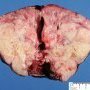 Renal malignant rhabdoid tumor