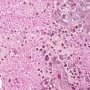 Pulmonary localization of a malignant rhabdoid tumor