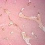 INI1/SNF5 (SMARCB1) negative immunostaining