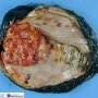 Cystic malignant rhabdoid tumor