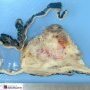 Cystic malignant rhabdoid tumor
