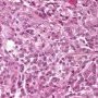Pulmonary localization of a malignant rhabdoid tumor