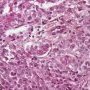 Pulmonary localization of a malignant rhabdoid tumor