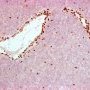 INI1/SNF5 (SMARCB1) negative immunostaining