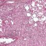 Pulmonary localization of a malignant rhabdoid tumor