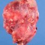 Renal malignant rhabdoid tumor