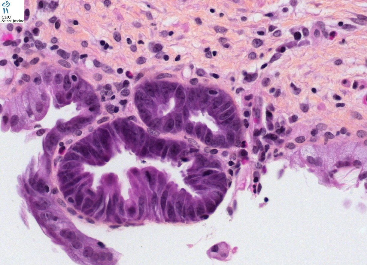 Choledochal Cyst Humpath Human Pathology Photos Pictures 