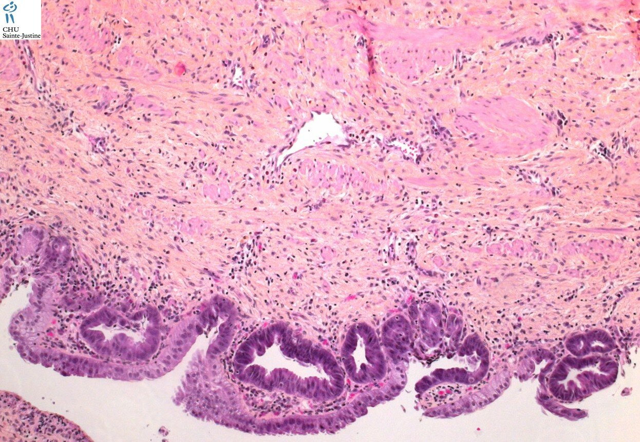 Choledochal Cyst Humpath Human Pathology Photos Pictures 