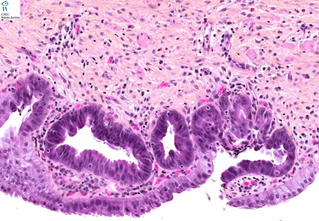 Choledochal Cyst Humpath Human Pathology Photos Pictures 
