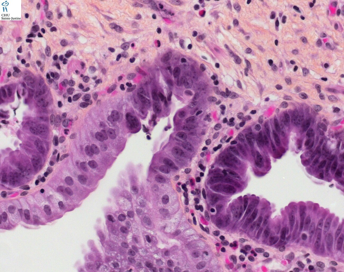 Choledochal Cyst Humpath Human Pathology Photos Pictures 
