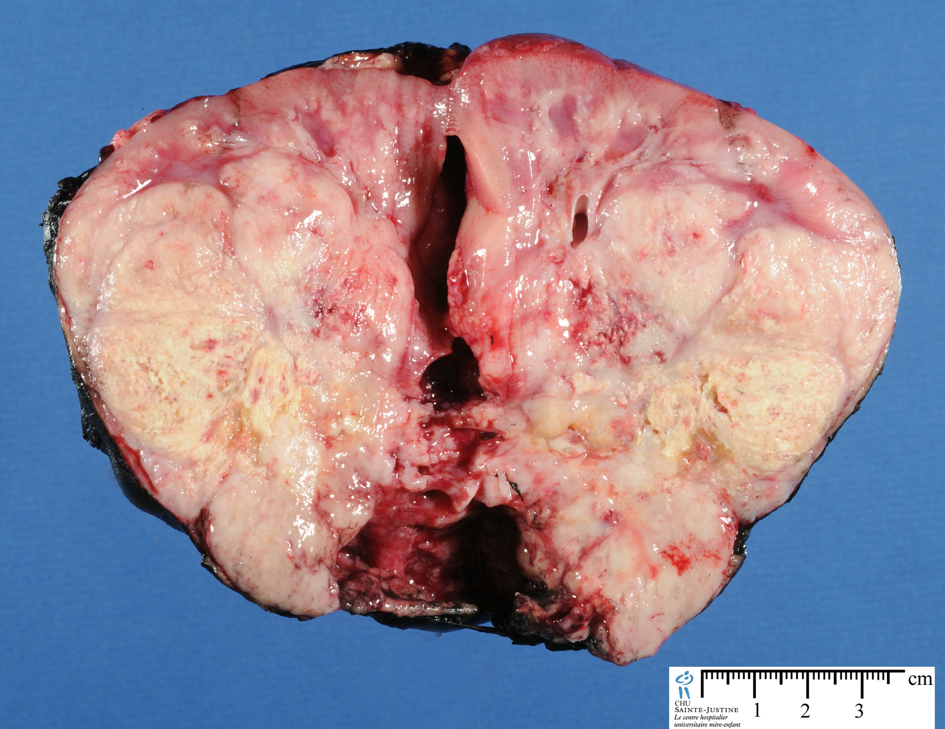 Renal malignant rhabdoid tumor
