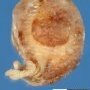 Cervical uterine leiomyoma