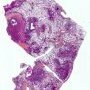 Progressive chronic pulmonary aspergillosis in cystic fibrosis