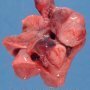 Extralobar pulmonary sequestration