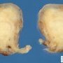 Cervical uterine leiomyoma