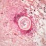 cutaneous north american brugiasis