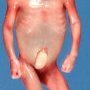 Facial dysmorphism in holoprosencephaly sequence (case 12063)