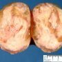 Myxoid degeneration of an uterine leiomyoma