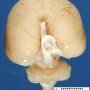 Alobar holoprosencephaly