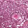 Yolk sac tumor