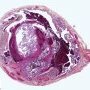Ectopic tubal pregnancy