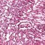 Yolk sac tumor
