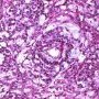 Yolk sac tumor