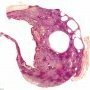 Hepatic mesothelial cysts