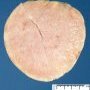 Necrobiotic subserosal uterine leiomyoma
