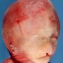 Facial dysmorphism in alobar holoprosencephaly (Case 13535)