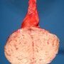Parietal uterine leiomyoma