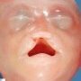 Facial dysmorphism in holoprosencephaly sequence (case 12063)