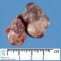Extralobar pulmonary sequestration
