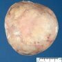Necrobiotic subserosal uterine leiomyoma