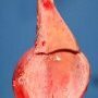Parietal uterine leiomyoma