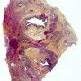 Progressive chronic pulmonary aspergillosis in cystic fibrosis