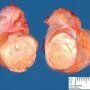 Testicular dermoid cyst