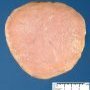 Necrobiotic subserosal uterine leiomyoma
