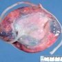 Long umbilical cord (37cm for normal at 15cm at 15 weeks)