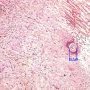 cutaneous north american brugiasis