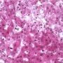 Minocycline-induced hepatitis